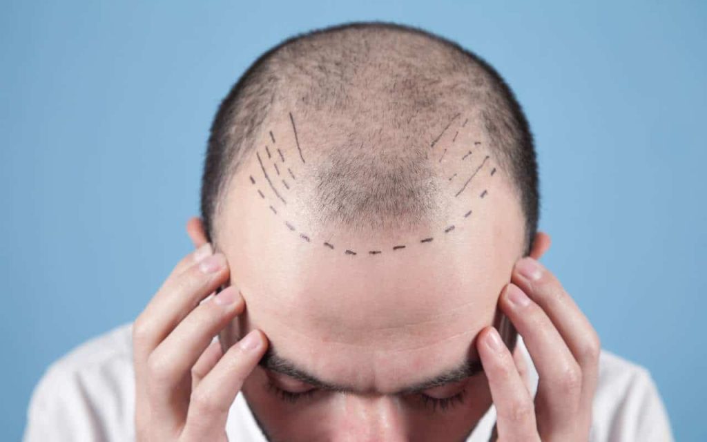 hair transplants