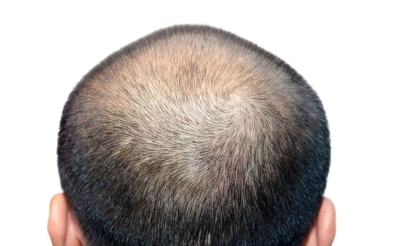 male pattern baldness