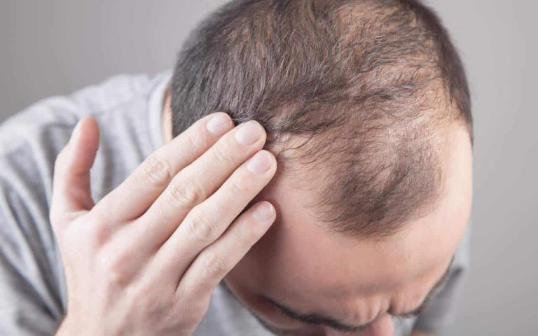 hair loss solutions