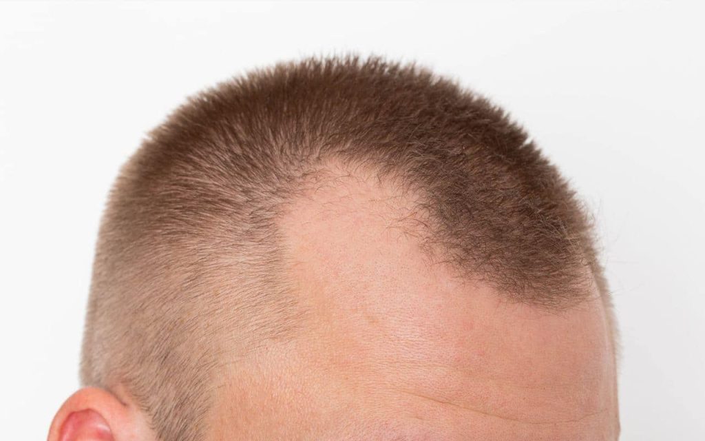 hair follicle