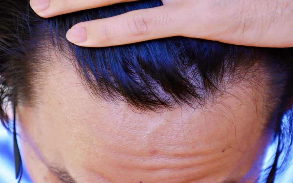 nw2 hairline