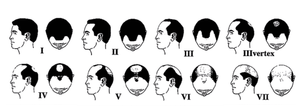 Diagram showing the different types of hairlines: straight, mature, low, middle, uneven, widow’s peak and receding