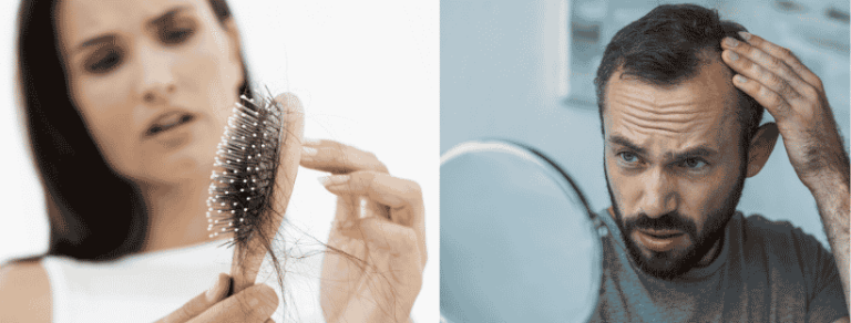 The Differences Between Male And Female Hair Loss