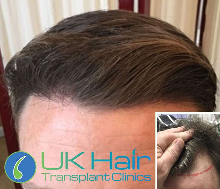 Best Hair Transplant in Turkey: The Top 20 Clinics Listed