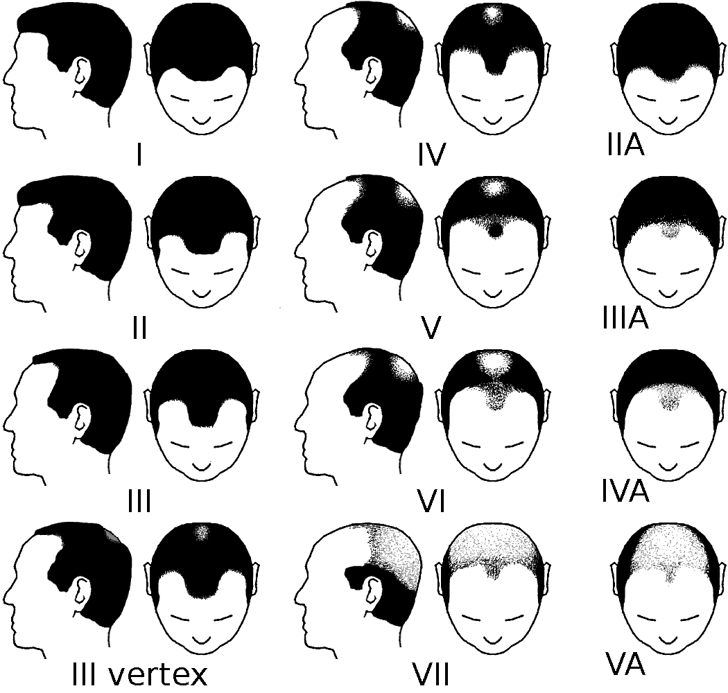 Norwood scale showing stages of male pattern hair loss