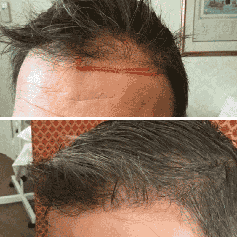 Men's hair transplant before and after result 1