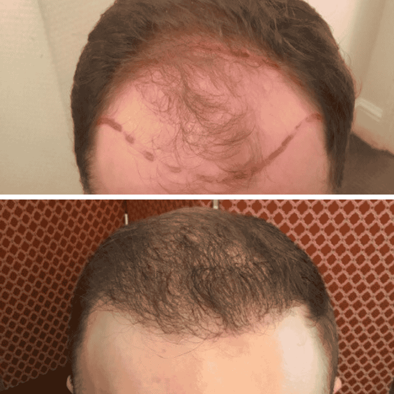 Men's hair transplant before and after result 2