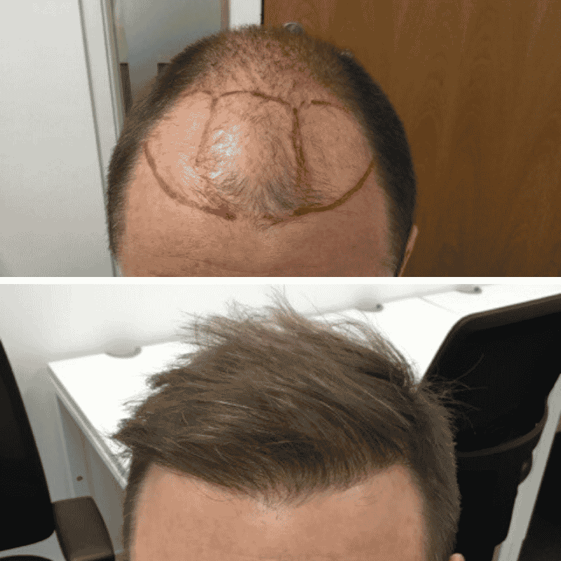 Men's hair transplant before and after result 3
