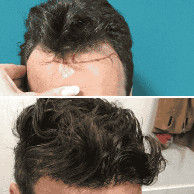 Men's hair transplant before and after result 4