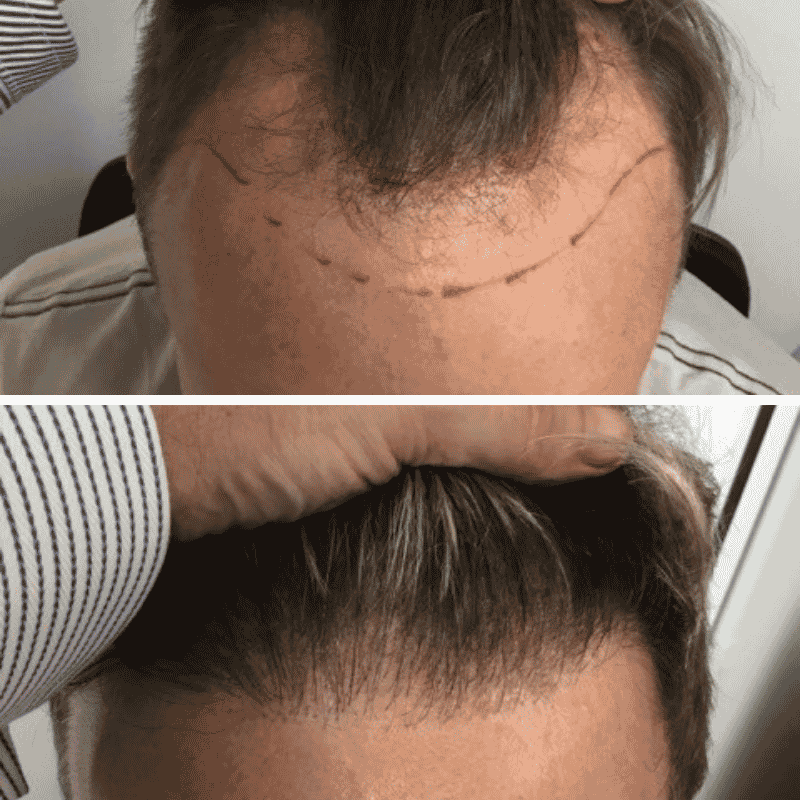 Men's hair transplant before and after result 5