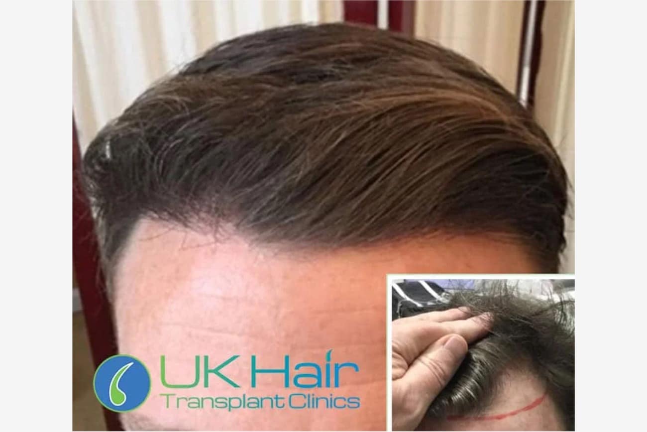 A hair loss consultation at a UK Hair Transplant Clinics clinic