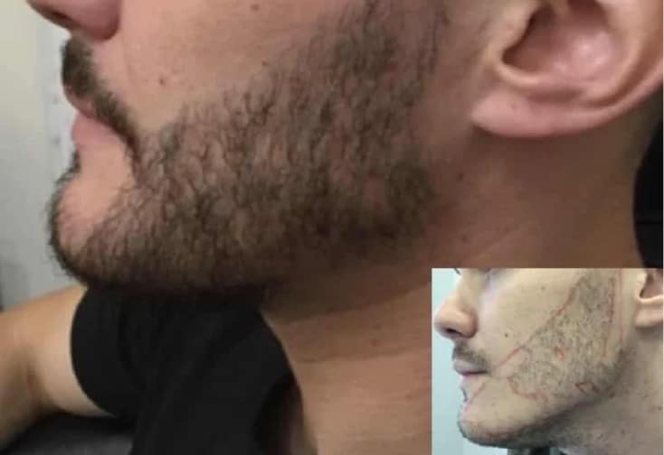 Beard Transplants