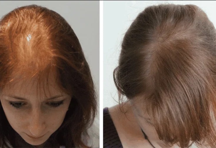 Female Hair Loss Solutions