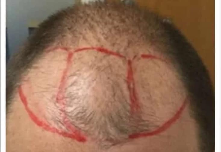 Men's Hair Transplants