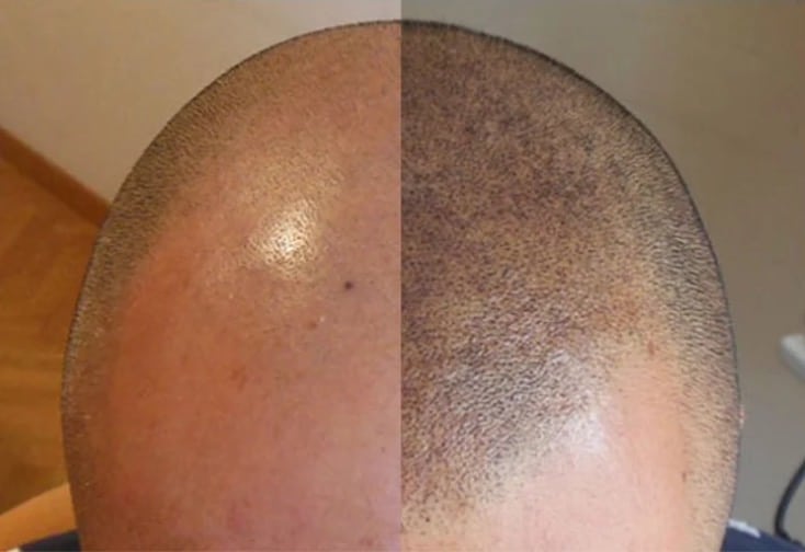 Scalp Micro Pigmentation