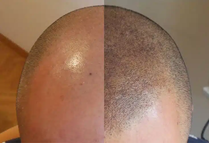 Scalp Micro Pigmentation