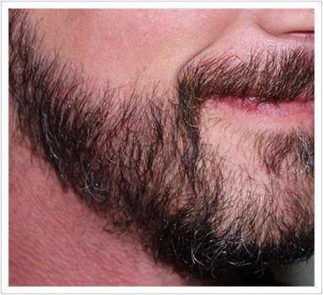 Beard transplant after, jawline and cheek filled with dense permanent hair