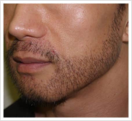 Beard transplant after, even beard coverage across the cheek and jaw