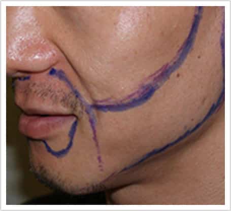 Beard transplant before, bare cheek and jaw with the design marked out