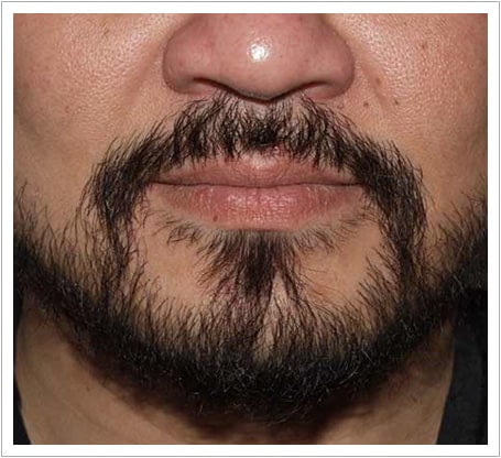 Beard transplant after, full moustache and goatee