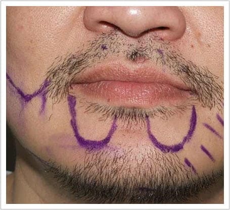 Beard transplant before, sparse moustache and goatee marked out