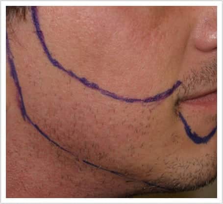 Beard transplant design marked out before surgery at UK Hair Transplant Clinics