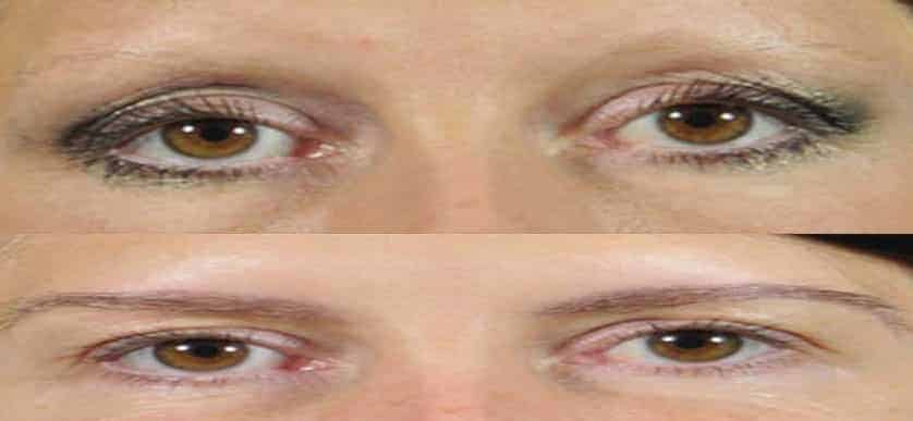Eyebrow transplant before and after, fuller brows restored