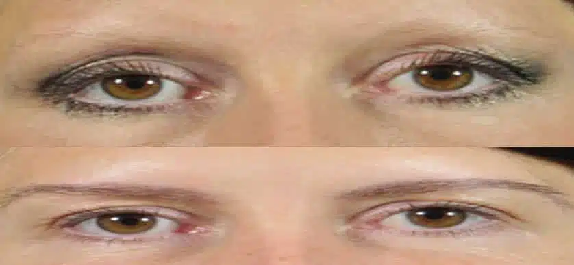 Eyebrow transplant before and after, fuller brows restored