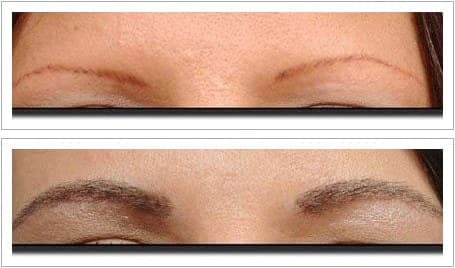 Eyebrow transplant before and after, sparse brows rebuilt