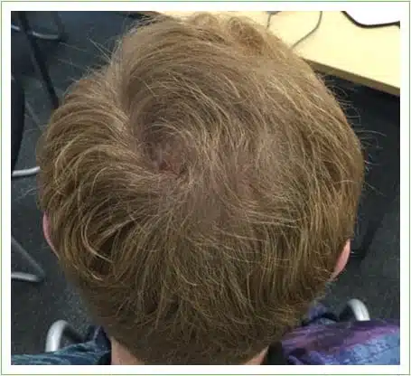 Crown Surgery hair transplant after
