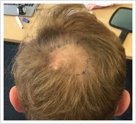 Crown Surgery hair transplant before