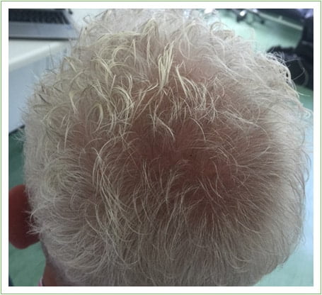 Crown Surgery hair transplant after, patient 3