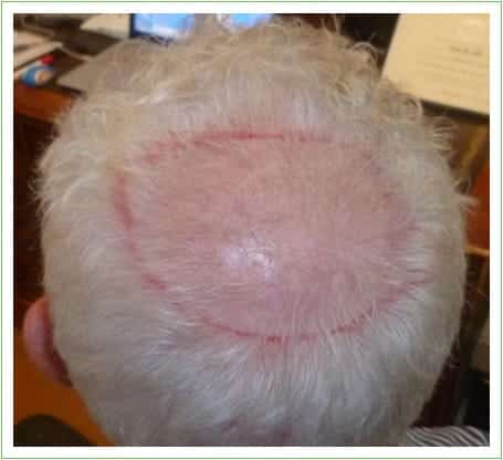 Crown Surgery hair transplant before, patient 3