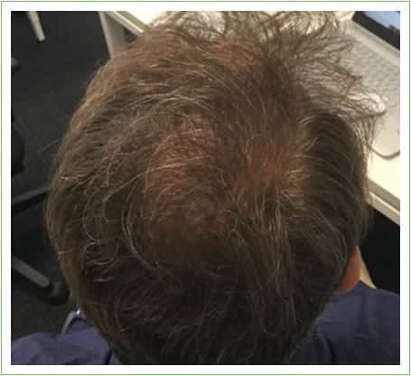 Crown Surgery hair transplant after, patient 4