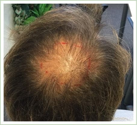 Crown Surgery hair transplant before, patient 4