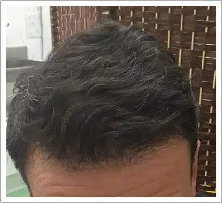 Front Surgery hair transplant after