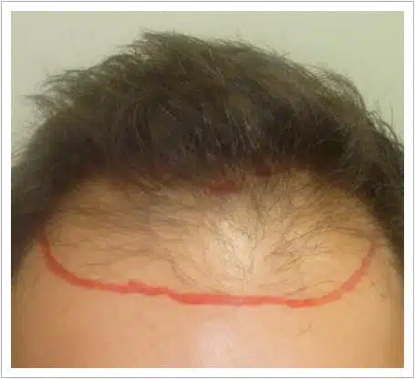 Front Surgery hair transplant before