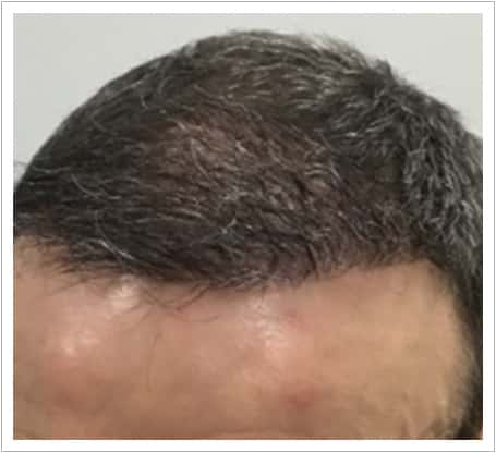 Front Surgery hair transplant after, patient 3