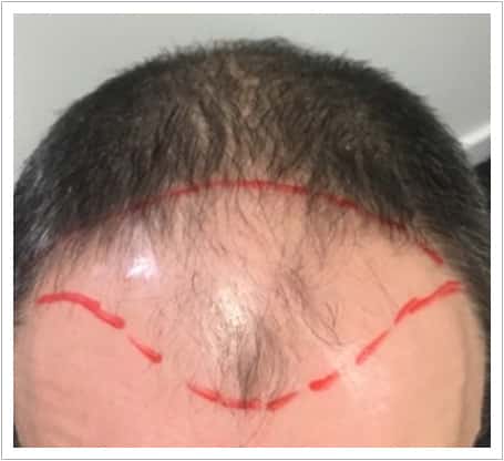 Front Surgery hair transplant before, patient 3
