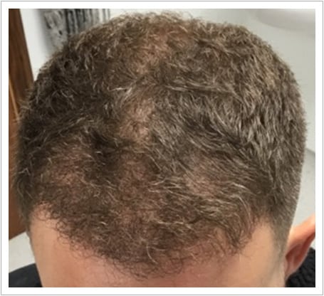 Front Surgery hair transplant after, patient 4