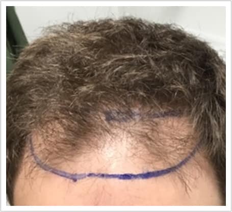 Front Surgery hair transplant before, patient 4