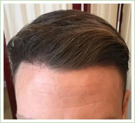 Hairline Surgery hair transplant after