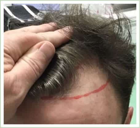 Hairline Surgery hair transplant before