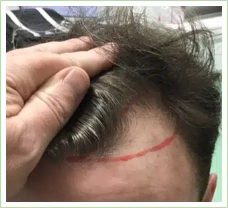 Hairline Surgery hair transplant before