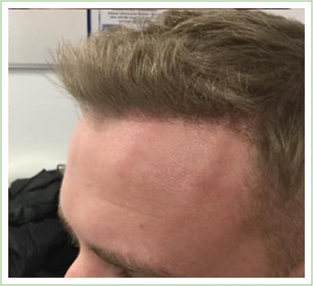 Hairline Surgery hair transplant after, patient 3