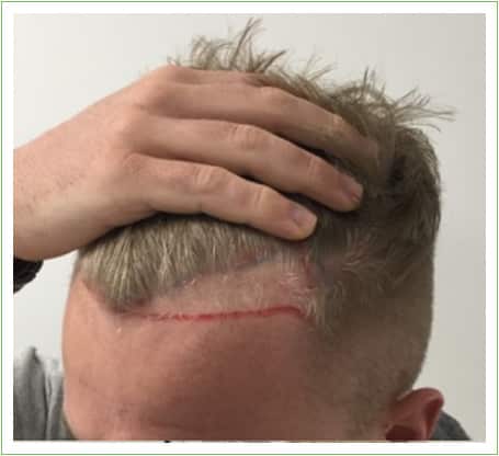 Hairline Surgery hair transplant before, patient 3