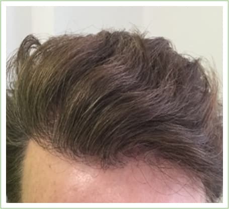 Hairline Surgery hair transplant after, patient 4