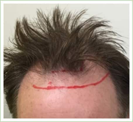 Hairline Surgery hair transplant before, patient 4
