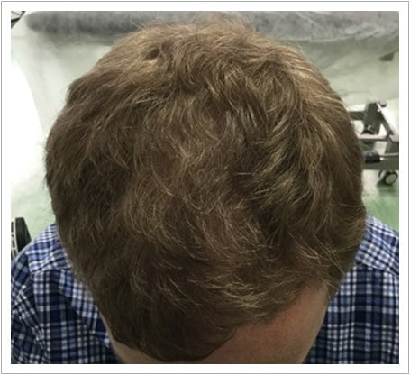 General Thinning hair transplant after