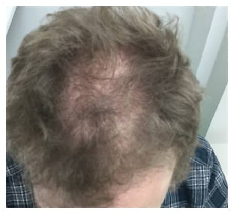 General Thinning hair transplant before